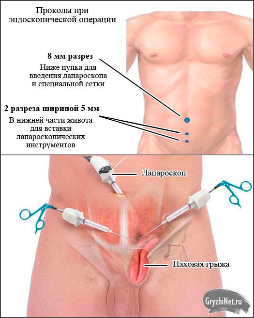 эндоскопическая операция при паховой грыже у мужчин